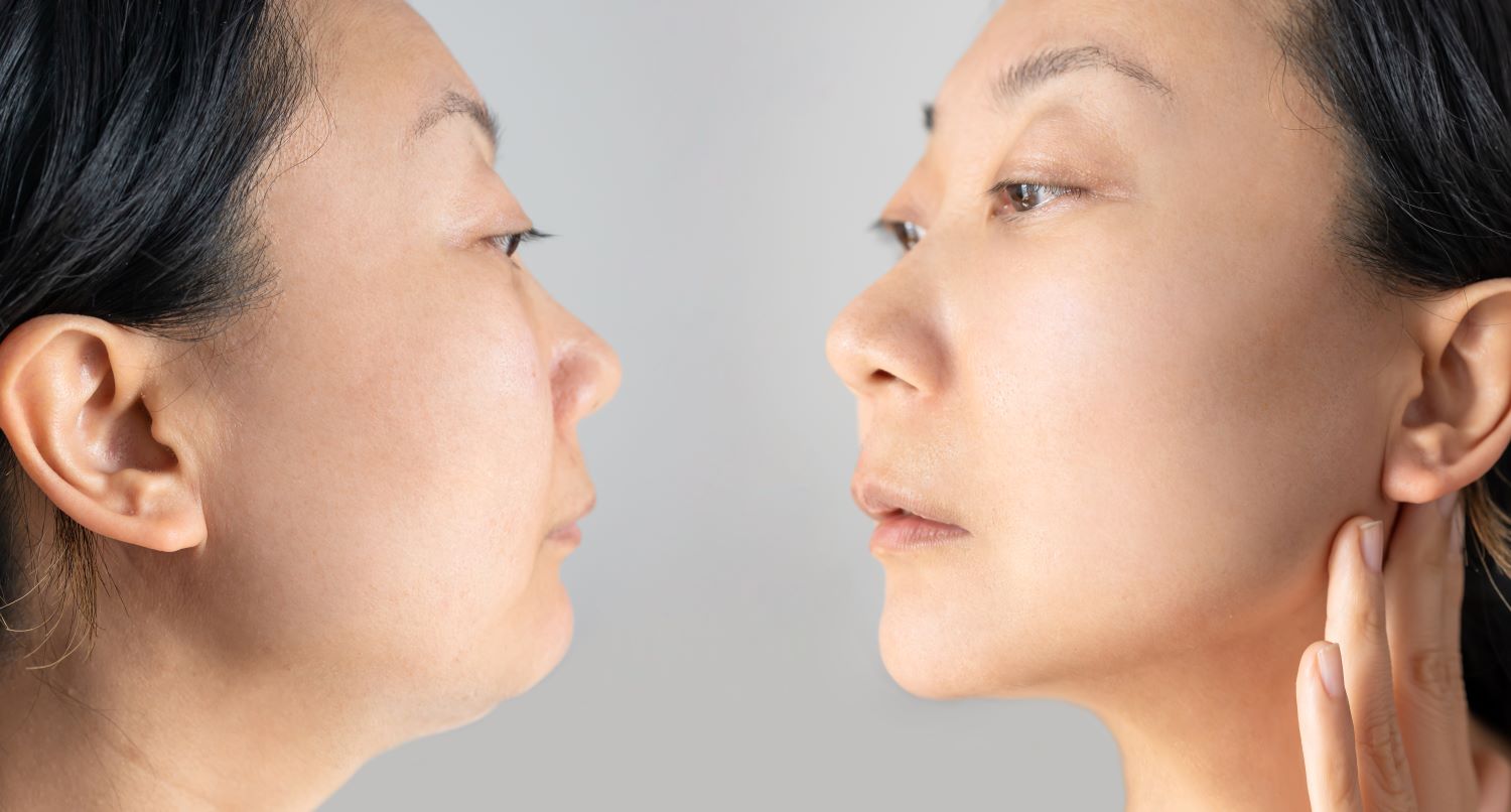 5ข้อควรรู้ก่อนดูดไขมันเหนียง : ทำแล้วต้องดูแลตัวเองยังไง?
